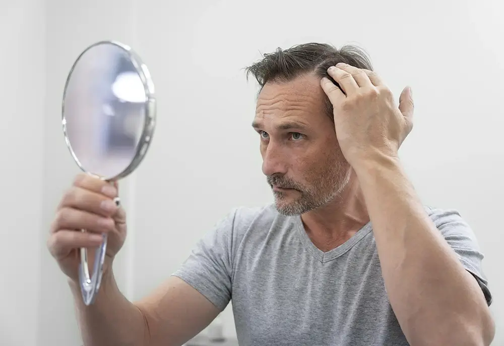 Queda de cabelo x calvície: entenda as diferenças e como tratar de forma eficaz